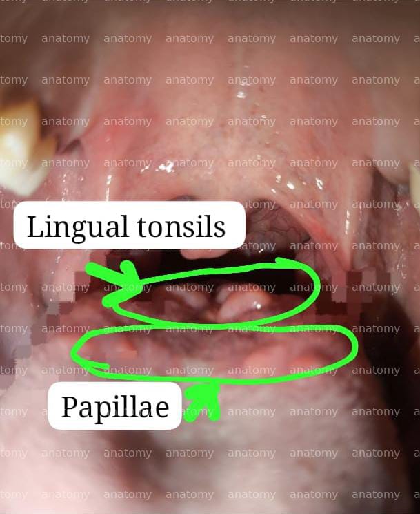 Tongue anatomy showing lingual tonsils and papillae